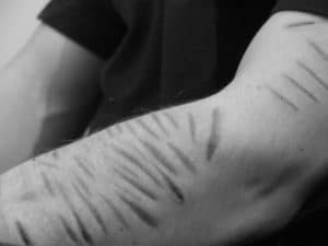 self harm scars